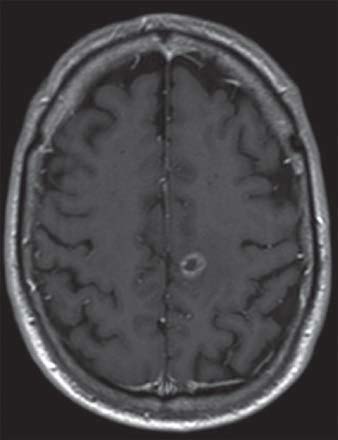Title métastases  dans l’hémisphère gauche du cerveau secondaire à un cancer du poumon - image A