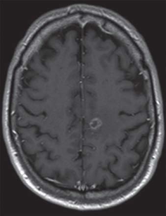 Title métastases dans l’hémisphère gauche du cerveau secondaire à un cancer du poumon B